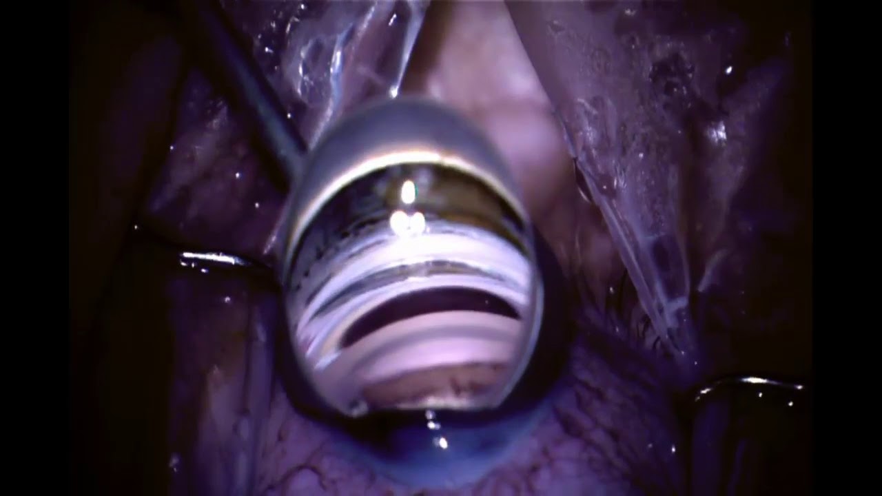 canaloplasty-treatments-in-pune