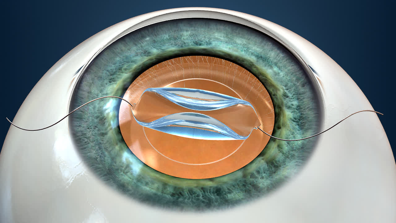 cataract-surgery-treatments-in-pune