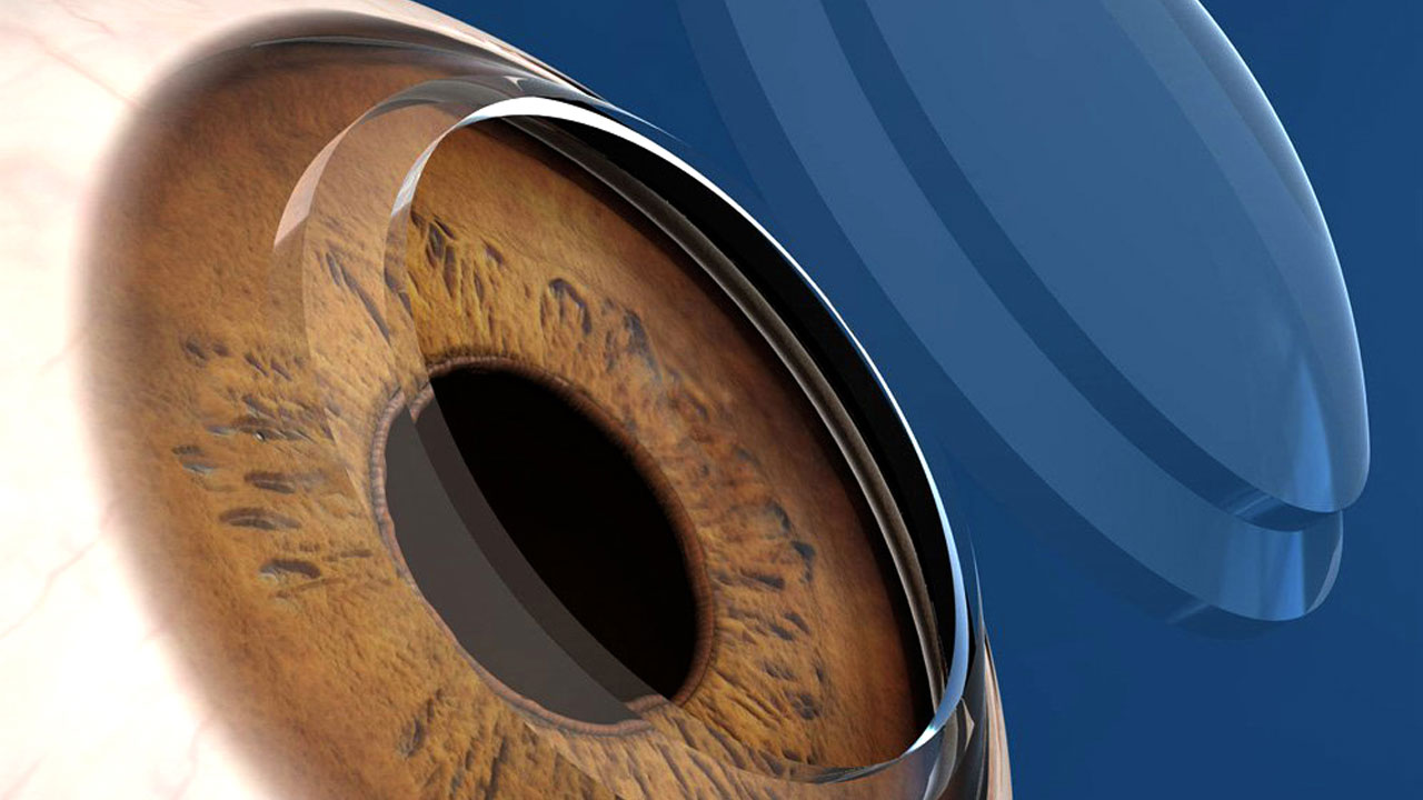 corneal-surgery-treatments-in-pune