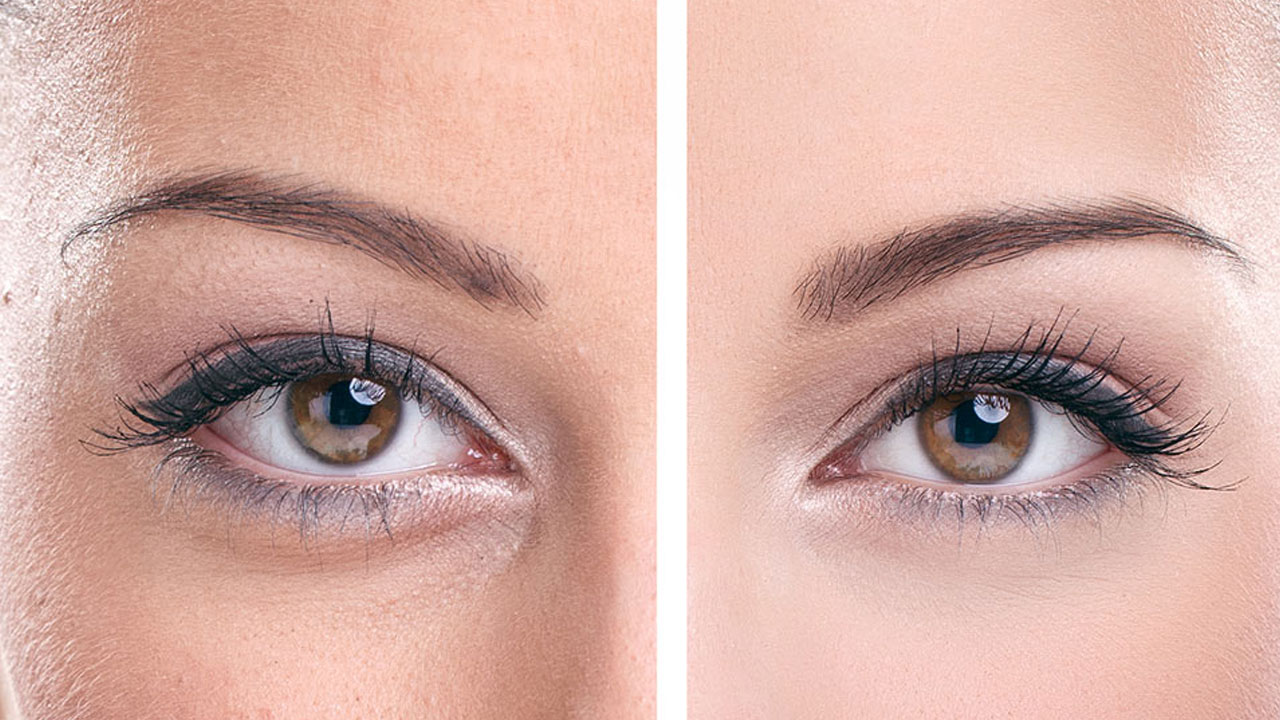 oculoplastic-surgery-treatments-in-pune