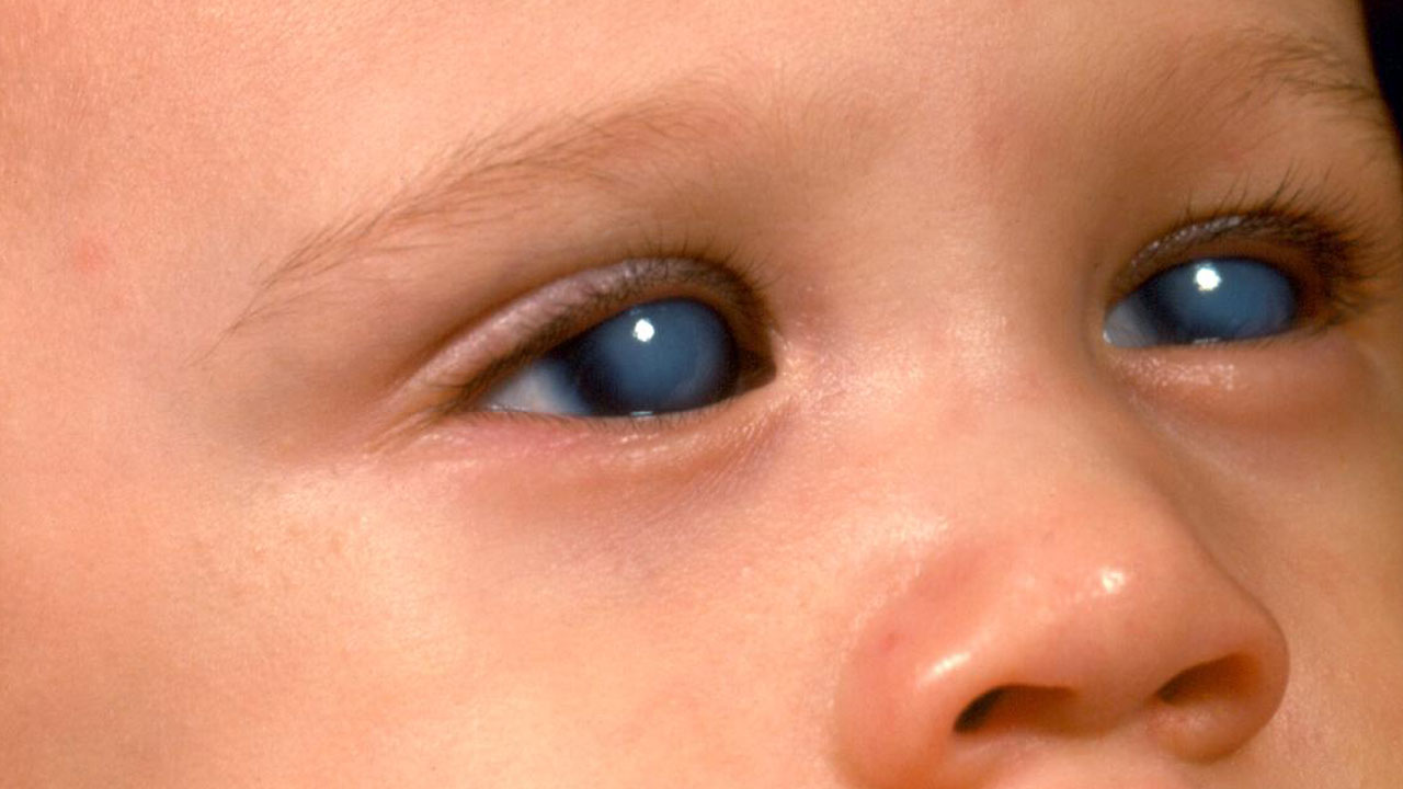 pediatric-glaucoma-management