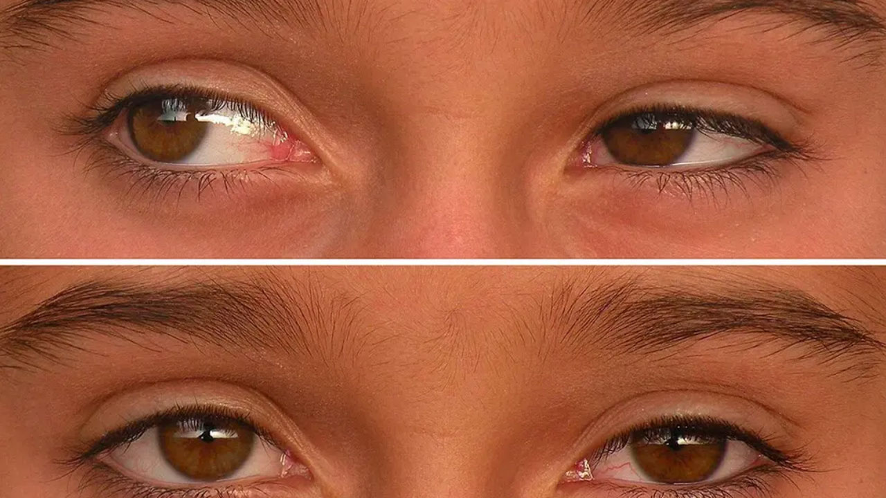 squint-surgery-treatments-in-pune