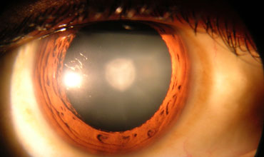 anterior-segment-surgery-img