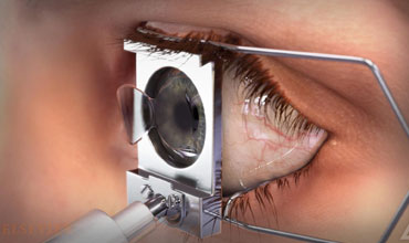 lasik-eye-surgery-img